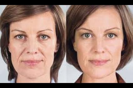 before and after 2