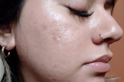 1st day after Morpheus8 treatment